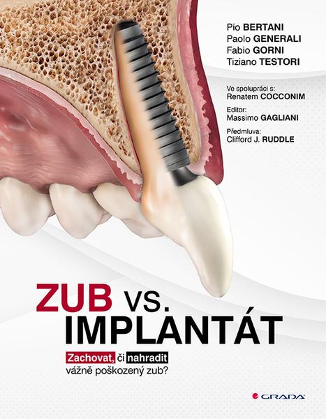 Levně Zub vs. implantát
