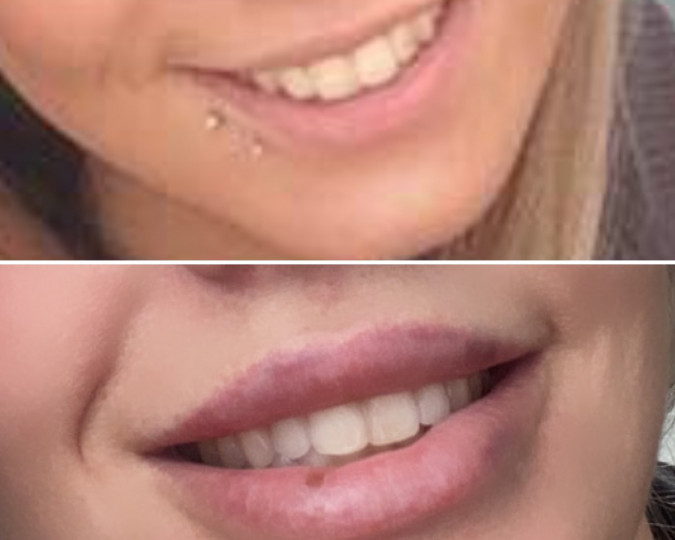 Lipfillers voor en na foto - 64702