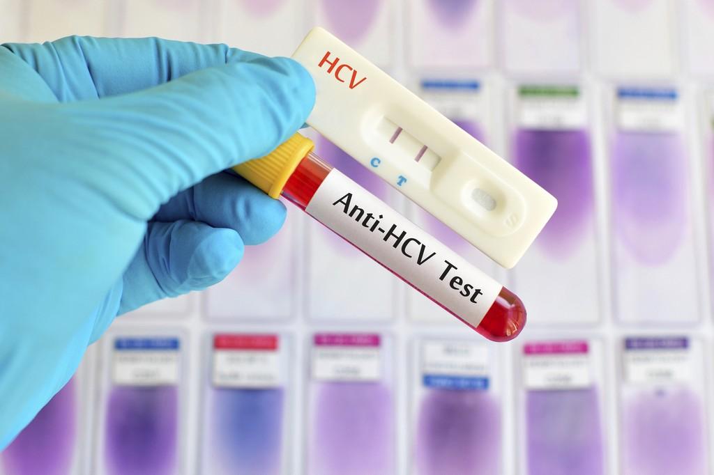 Expanding Hepatitis C testing to all adults is cost-effective - pilt 1 Expanding Hepatitis C testing to all adults is cost-effective - pilt 1