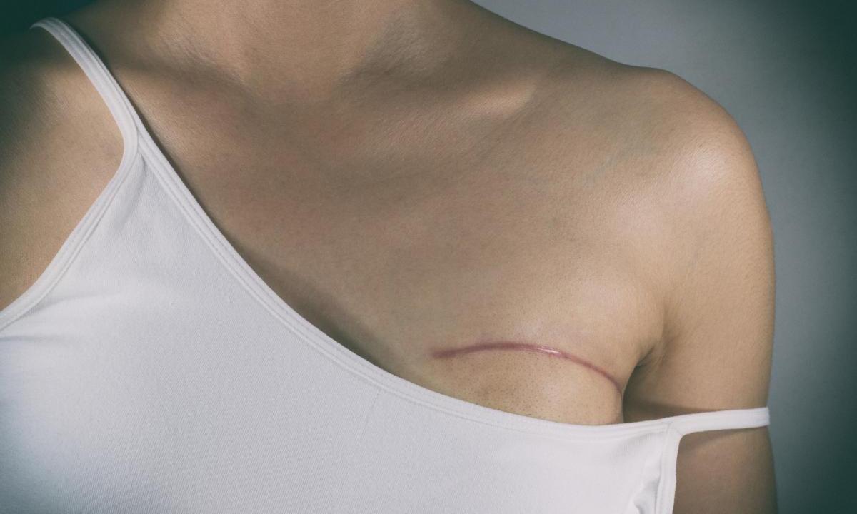 Mortality from breast cancer is more common among women with HIV - صورة 1 Mortality from breast cancer is more common among women with HIV - صورة 1
