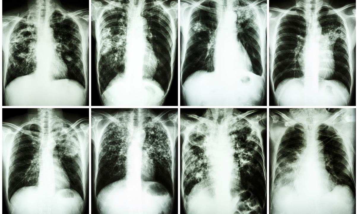 New TB Vaccine May Appear Recently - picture 1 New TB Vaccine May Appear Recently - picture 1