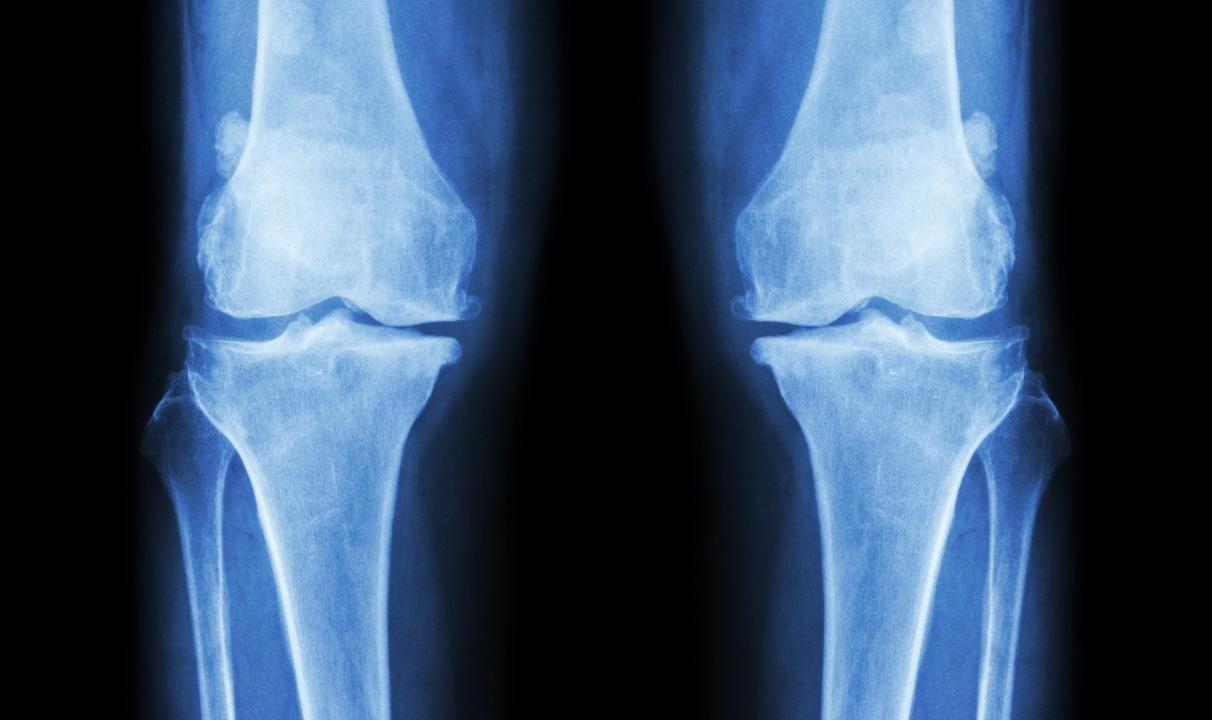 Bone Problems Appear to HIV-Positive People At an Earlier Age - picture 1 Bone Problems Appear to HIV-Positive People At an Earlier Age - picture 1