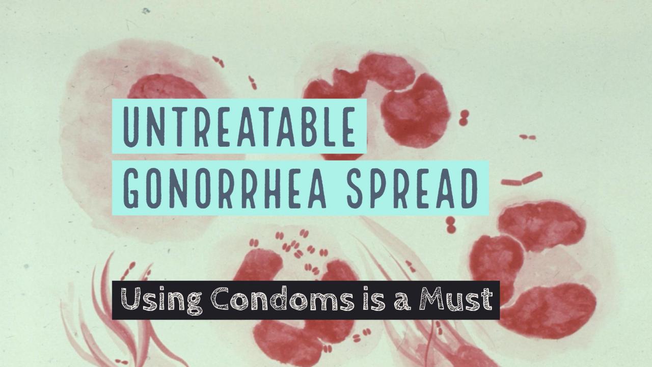 Oral Sex Spreading Antibiotic-resistant Gonorrhea — Using Condoms is a Must. - picture 1 Oral Sex Spreading Antibiotic-resistant Gonorrhea — Using Condoms is a Must. - picture 1