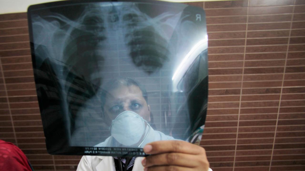 Diagnostika für Tuberkulose noch immer zu teuer - Bild 1 Diagnostika für Tuberkulose noch immer zu teuer - Bild 1
