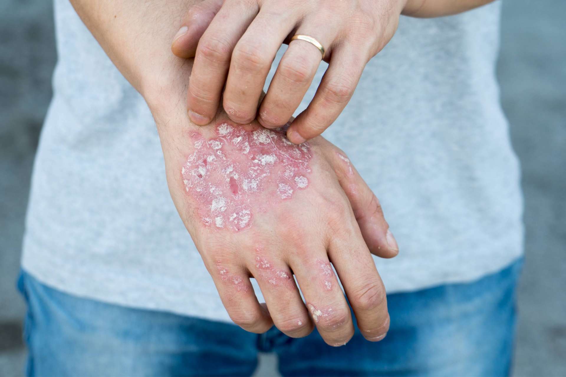 Wat is psoriasis?