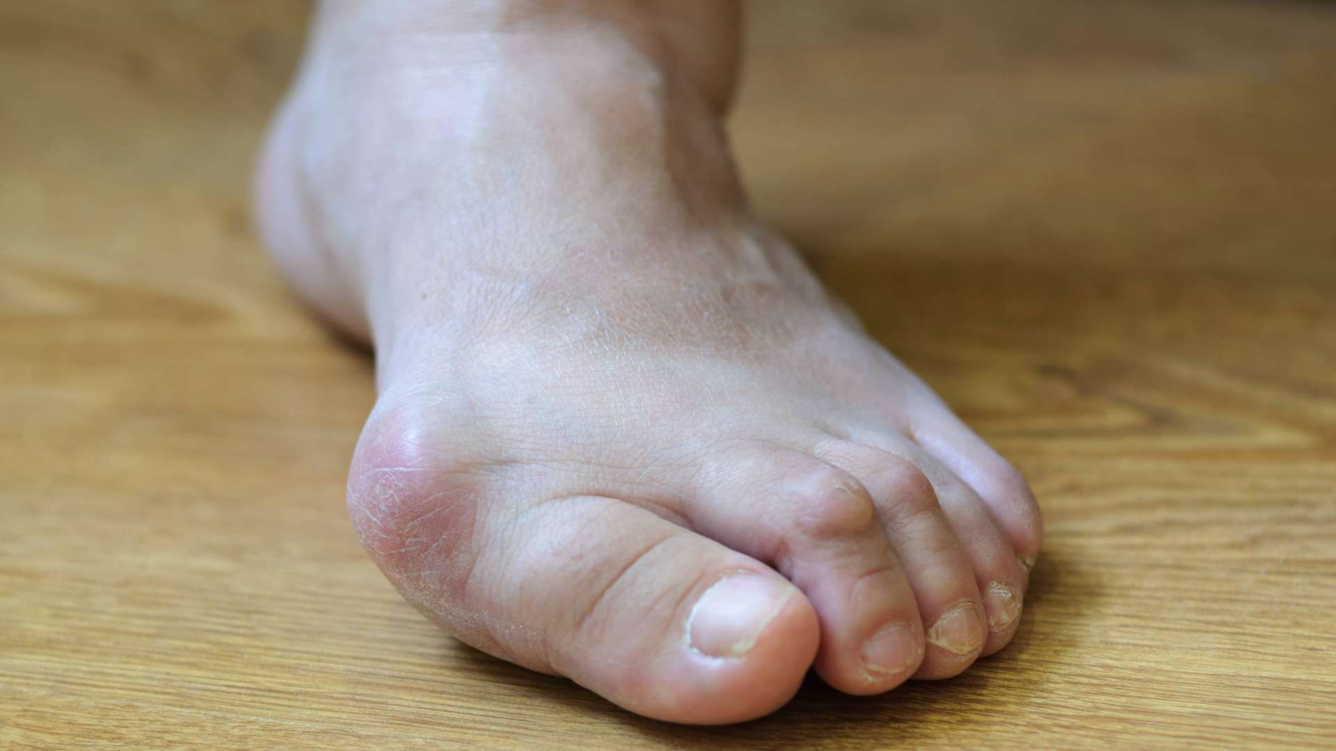 Wat is een scheve grote teen (of hallux valgus)?