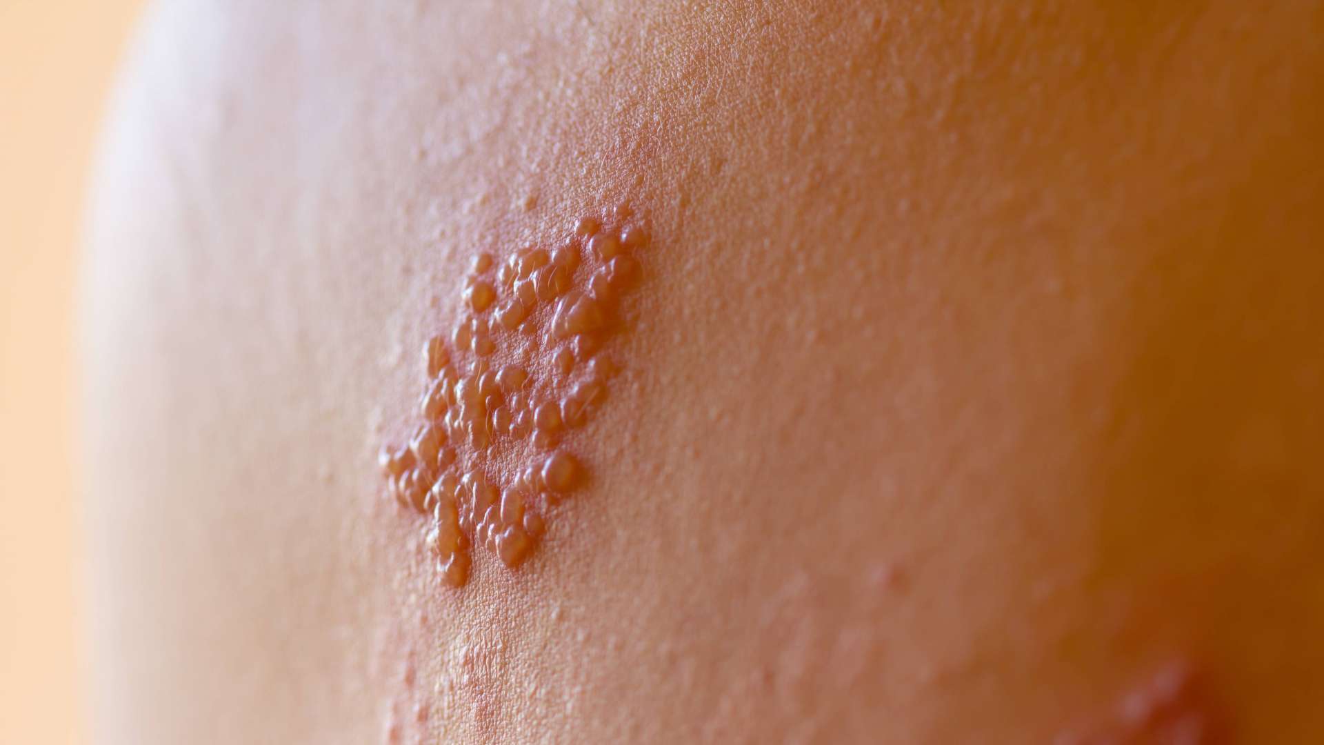 Wat is herpes zoster? Wat is herpes zoster?