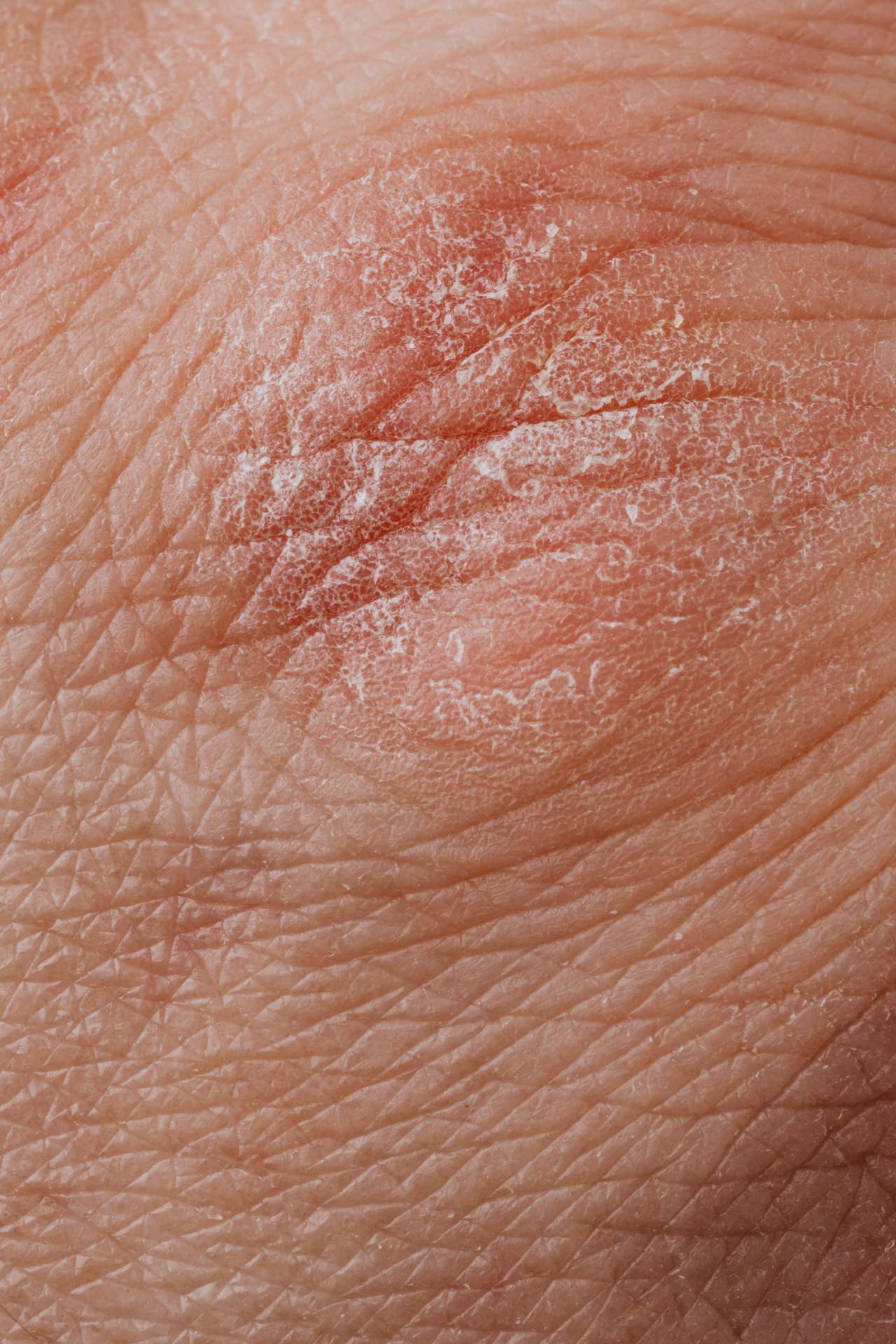 Atopie: tips voor een aangenamer leven met atopische dermatitis Atopie: tips voor een aangenamer leven met atopische dermatitis