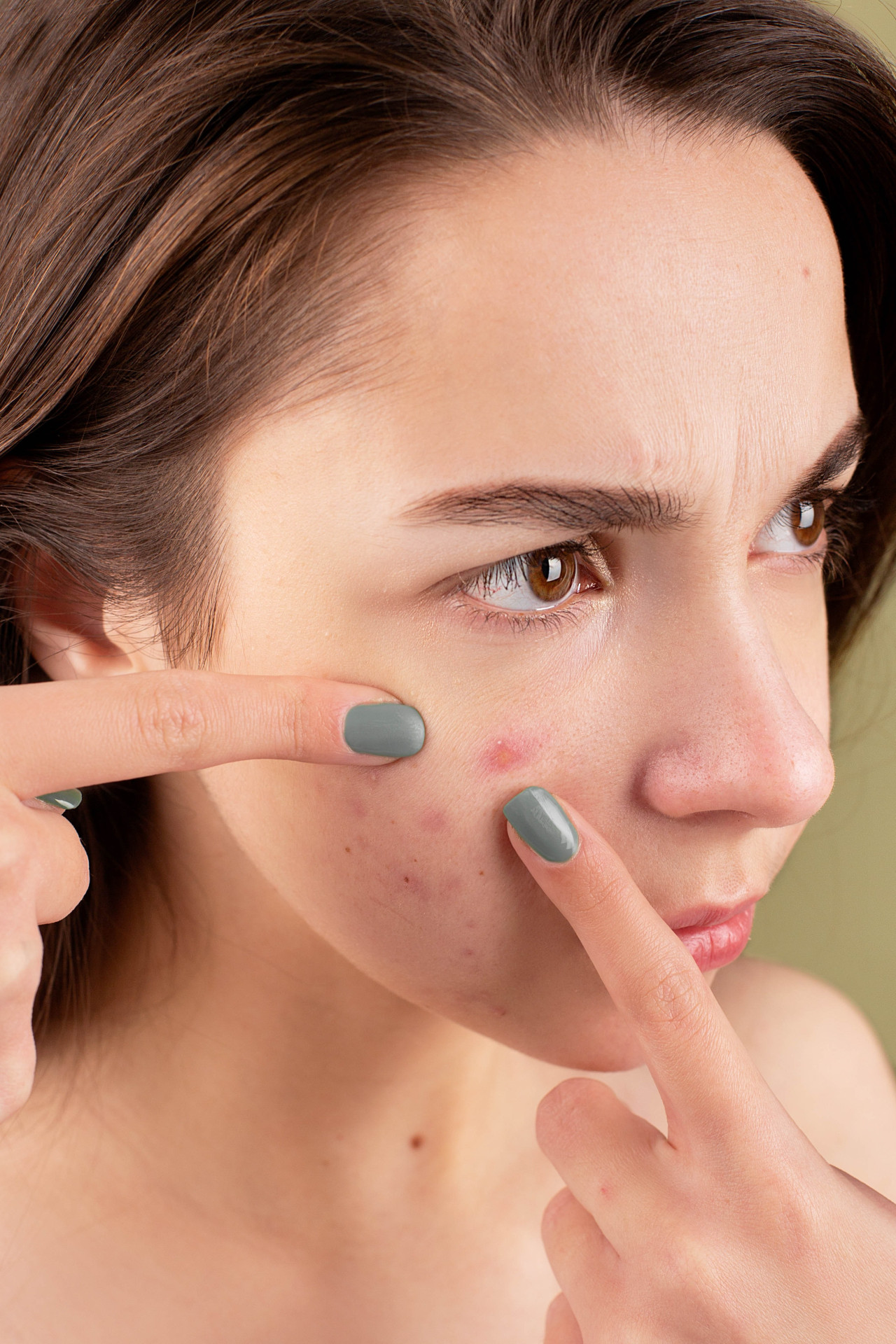 Hoe behandel je acne?