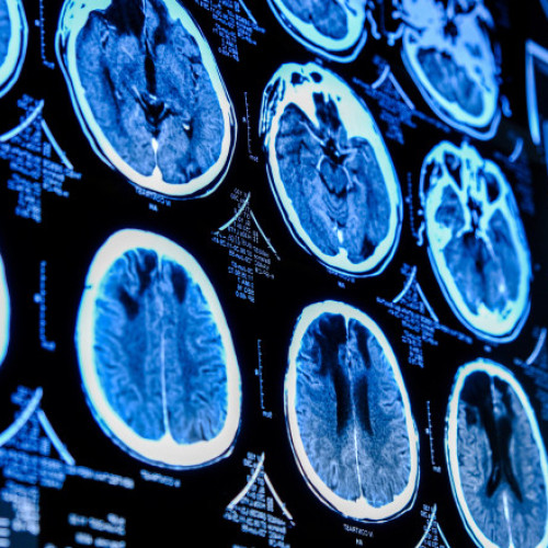 Studiu nou: Efectele negative ale unei diete nesănătoase asupra creierului