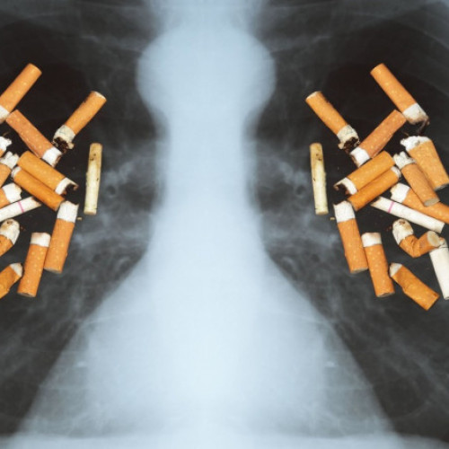 Medicul pneumolog Cristian Oancea avertizează asupra riscurilor cancerului bronho-pulmonar