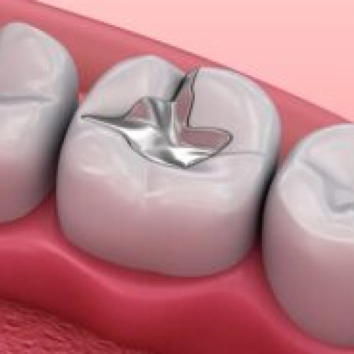 Interdicția utilizării amalgamului dentar în Uniunea Europeană, începând cu 2025