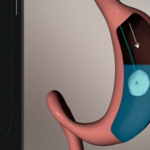 Autoritățile sanitare din Franța cer retragerea balonului gastric Allurion