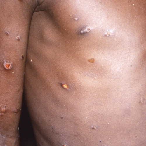 Mpox, declarată urgență de sănătate publică în Africa