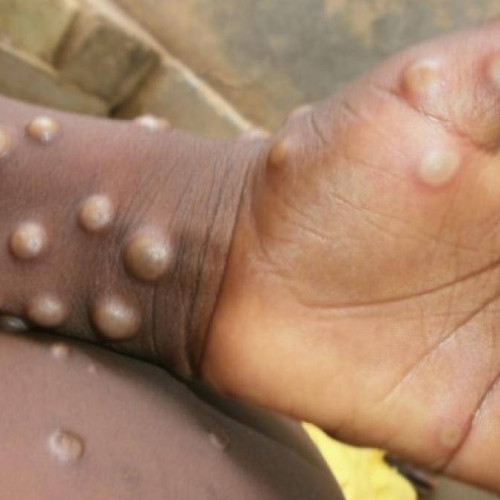 OMS declară o nouă urgență globală din cauza epidemiei de mpox în Africa