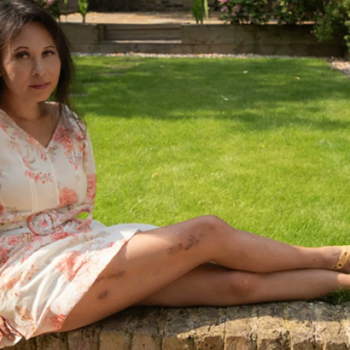 Durerea și chinul unei femei din Londra după o operație de alungire a picioarelor