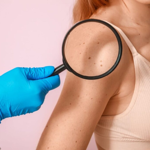 Cancerul de piele: Informatii esentiale despre prevenire si recunoastere