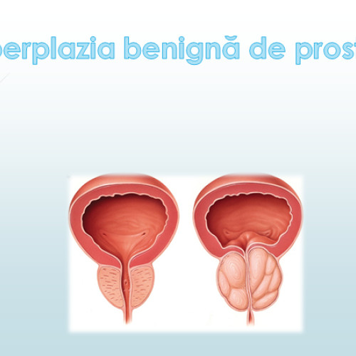 Problemele cu prostata devin tot mai comune în rândul bărbaților