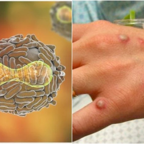 Noul val de infectări cu variola maimuței în Africa