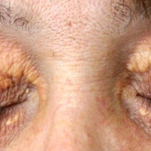 Xantelasmele: un semnal de alarmă pentru sănătatea lipidică