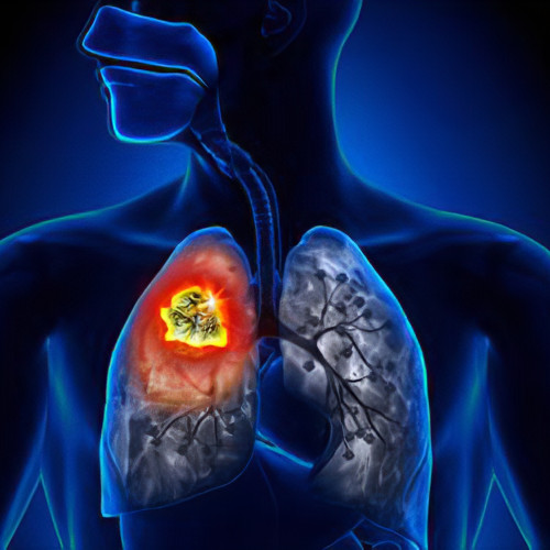 Dezbatere pe tema afecțiunilor pulmonare și măsurile necesare în România