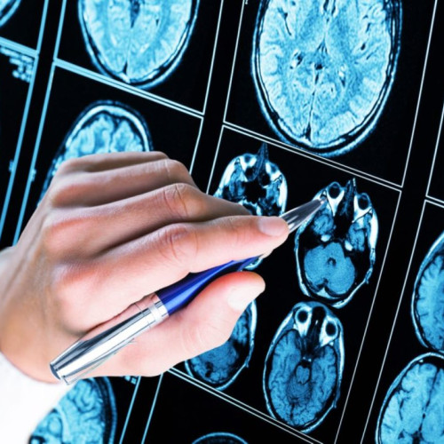 Creșterea cazurilor de demență vasculară: cauze, simptome și soluții de tratament