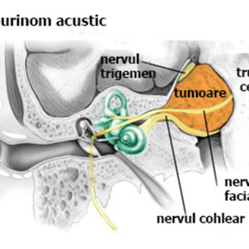 Mama afectată de neurinom de acustic, în căutarea unui diagnostic suplimentar