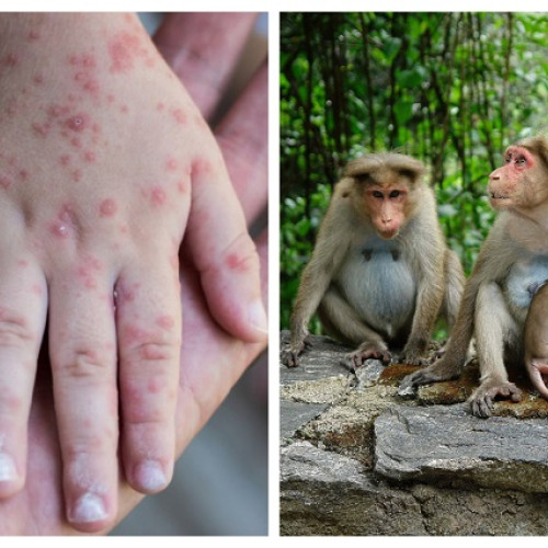 Se răspândește o nouă variantă a virusului mpox, cunoscut și sub numele de varioala maimuței