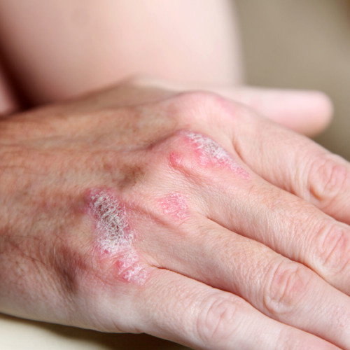 O nouă descoperire pentru tratamentul psoriazisului