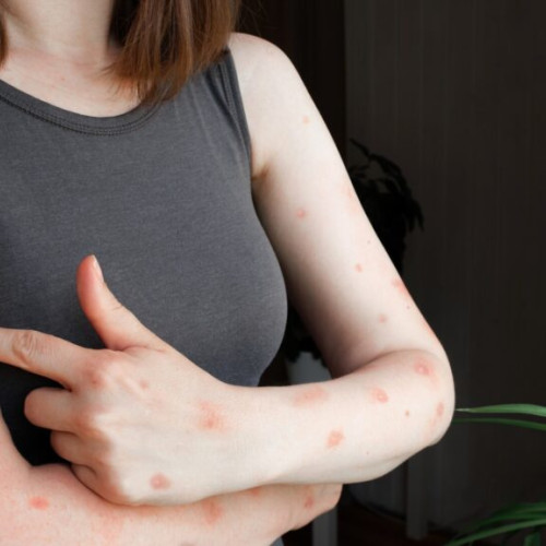 Un nou caz de mpox, varianta cladei Ib, confirmat în Anglia