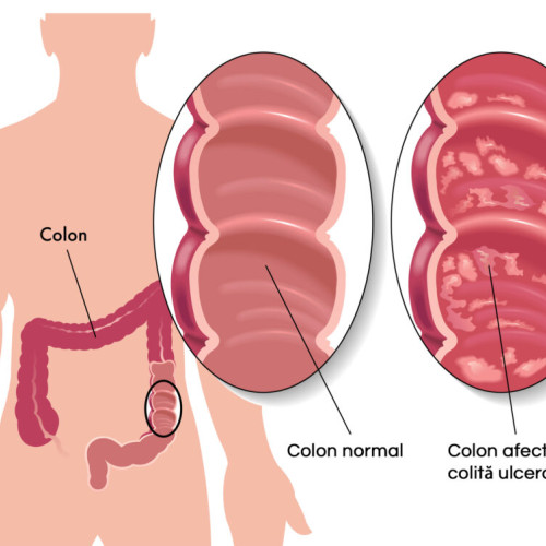 Probleme grave de sănătate la Stefania Preda din România