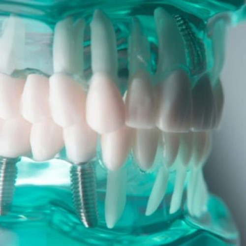 alegerea implantului dentar: ieftin sau premium?