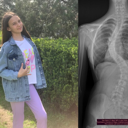 Ilaria, o fetiță de 14 ani, se luptă cu scolioza severă și are nevoie de ajutor