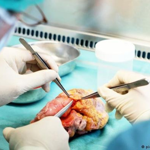 O femeie din SUA a primit un rinichi de porc editat genetic