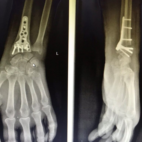 Fracturile de radius distal, o problemă frecventă în sezonul rece