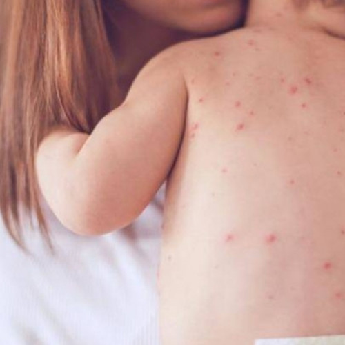 Cresc cazurile de rujeolă în România