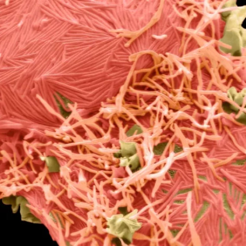 Confirmare a unui caz de metapneumovirus uman în Bihor