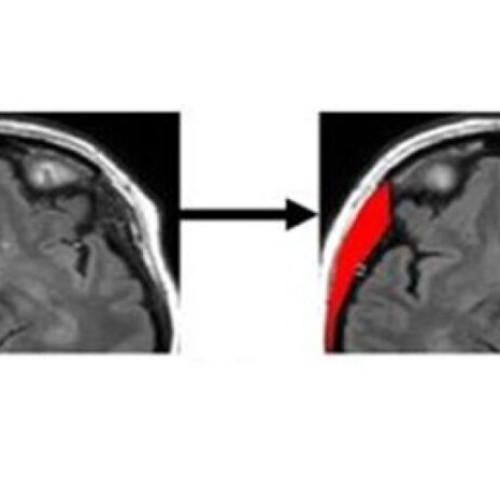 Pierderea mușchilor scheletici, factor de risc pentru demență, conform unui studiu