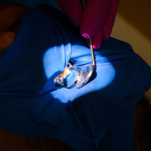 Eroziunea dentară: Cauze și soluții de tratament