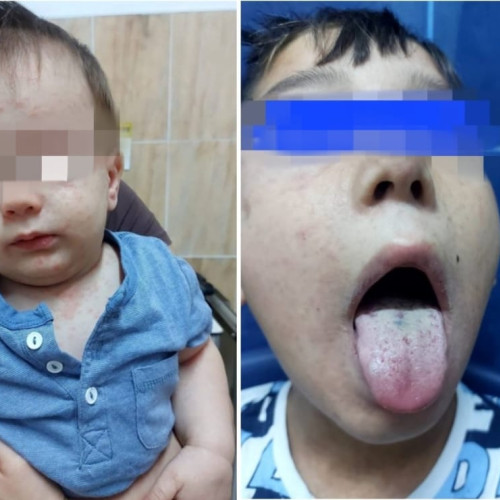 Numărul internărilor cu rujeolă la Spitalul Clinic de Boli Infecțioase Constanța scade