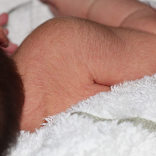 Bebelusi din Europa afectati de "sindromul varcolacului" dupa expunerea la un tratament pentru caderea parului