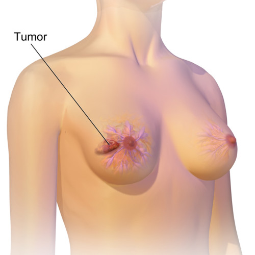 Nouă descoperire privind metastazele cancerului de sân și predicțiile genetice