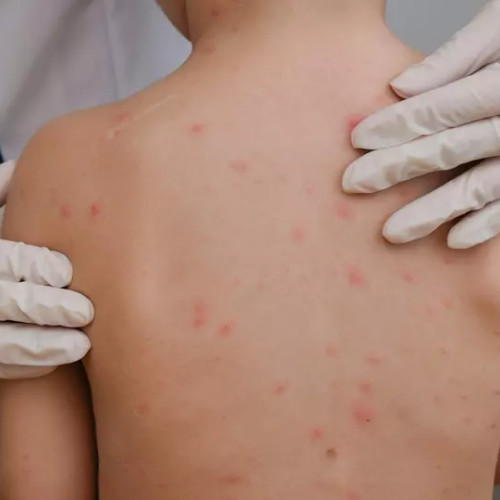 Rujeola, o amenințare gravă: Spitalul Județean Piatra Neamț face apel la părinți