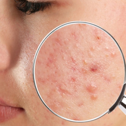 Cosurile sub piele: Cauze, tipuri și metode de tratament