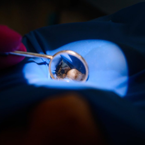 Clinica de medicina dentară DR TEO: Importanța tratării cariilor dentare