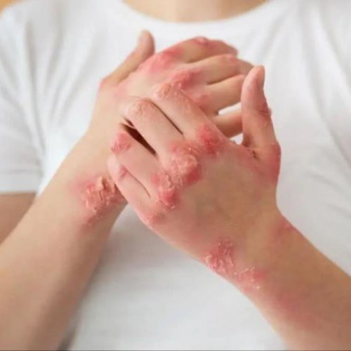 Creștere alarmantă a cazurilor de psoriazis în Botoșani