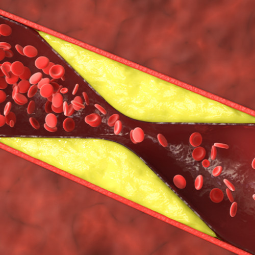 Monitorizarea LDL-C esențială în prevenția bolilor cardiovasculare
