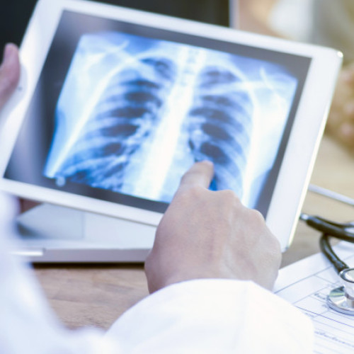 Tuberculoza afectează grav populația din România