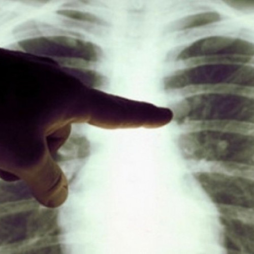 Un bărbat de 75 de ani își povestește lupta cu tuberculoza