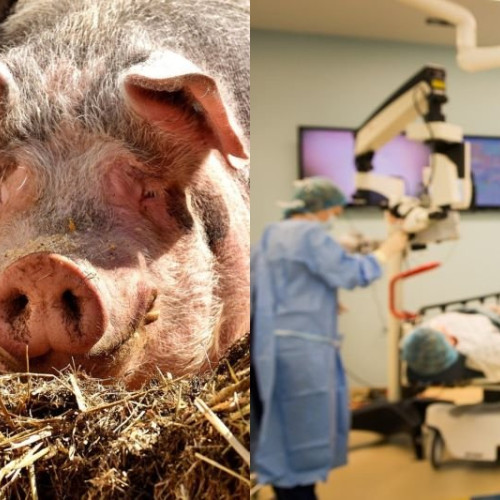 Transplant de ficat de porc la un pacient uman, premieră mondială